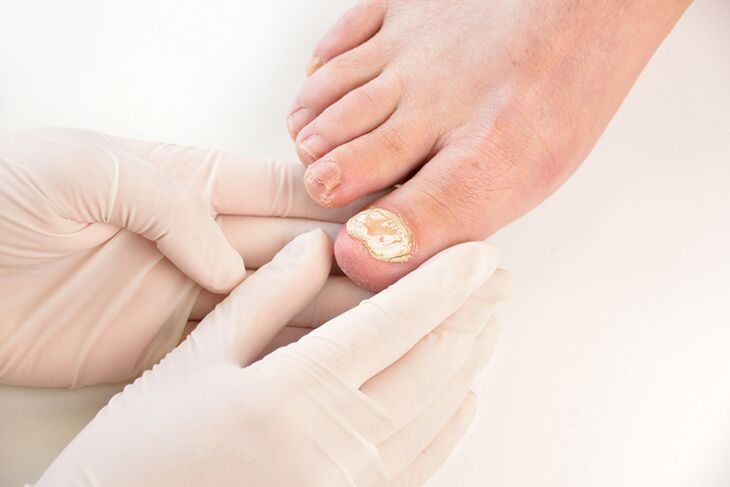 Πριν συνταγογραφήσει τη θεραπεία, ο γιατρός πρέπει να διαγνώσει τον μύκητα των νυχιών των ποδιών
