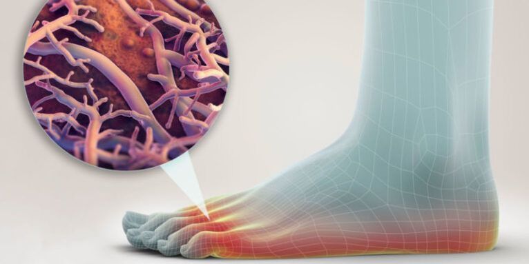 Πώς μολύνεται η μυκητίαση;