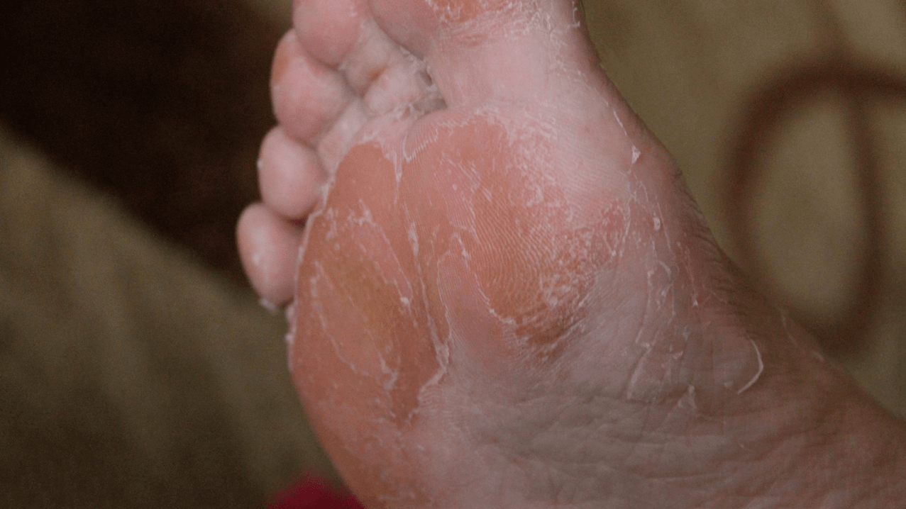 Μύκητας του δέρματος των ποδιών