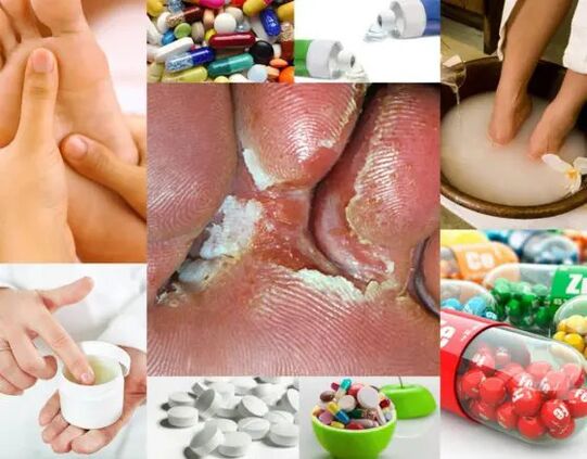 Διαδικτυακή μυκητίαση και μέθοδοι θεραπείας